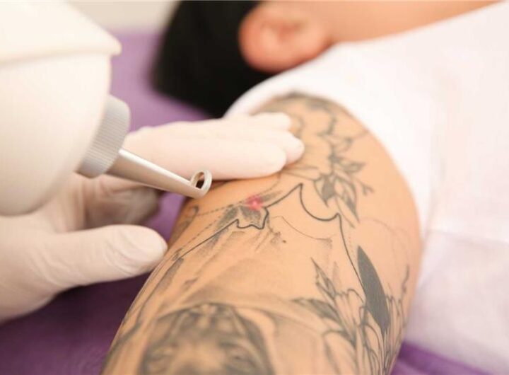 Laser Tattoo Removal in Abu Dhabi Erase Unwanted Ink