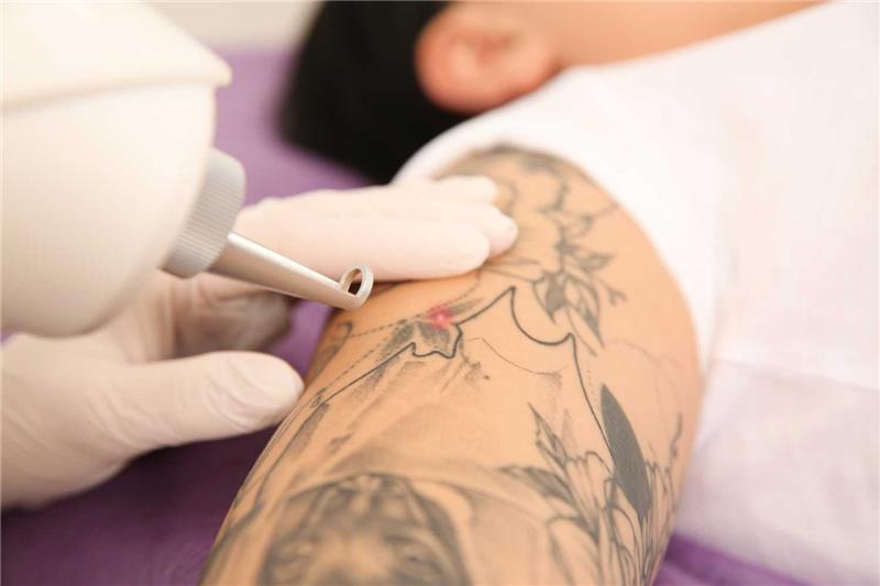 Laser Tattoo Removal in Abu Dhabi Erase Unwanted Ink